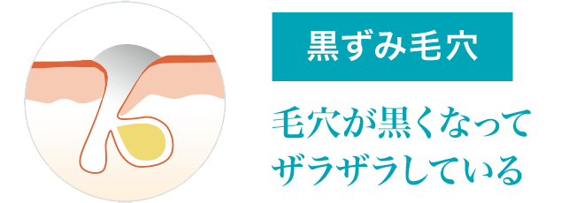 黒ずみ毛穴タイプ 毛穴が黒くなってザラザラしている