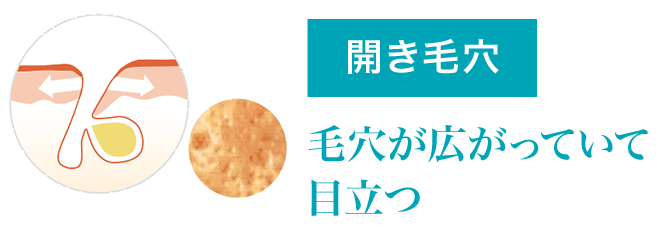 開き毛穴タイプ 毛穴が広がっていて目立つ