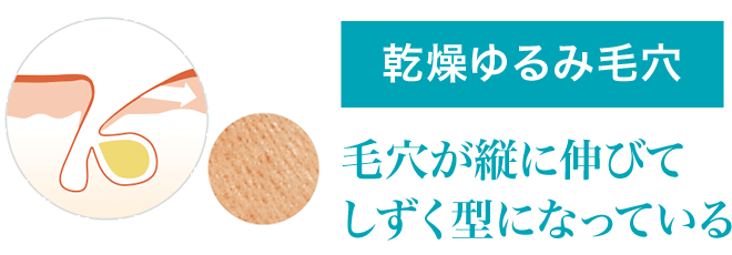 乾燥ゆるみ毛穴タイプ 毛穴が縦に伸びてしずく型になっている