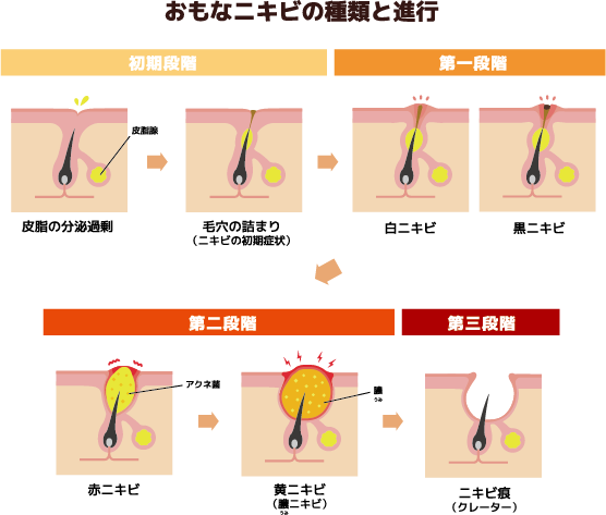 赤 ニキビ 治し 方