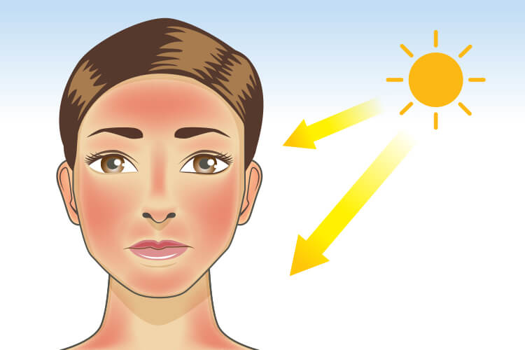 日焼けにも種類があるの 日焼けしてしまったときの効果的なアフターケアとは 無添加化粧品 健康食品 サプリメント通販のファンケルオンライン