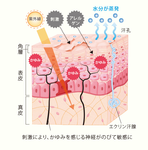 刺激により、かゆみを感じる神経がのびて敏感に