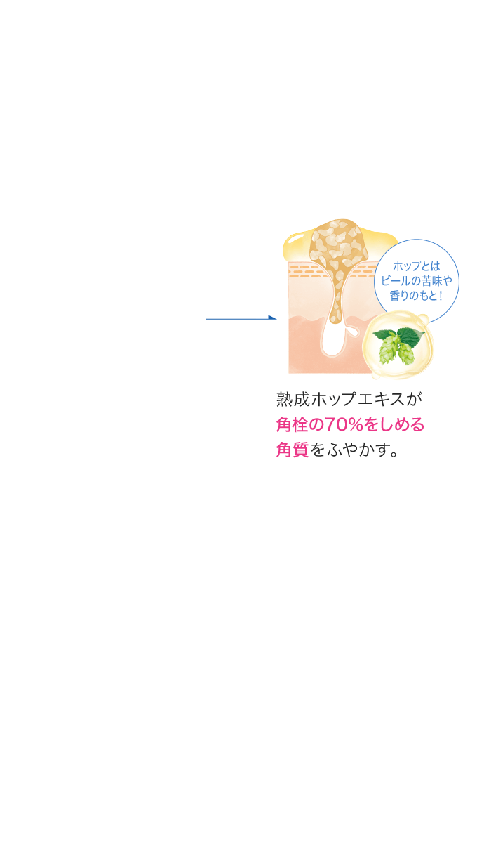 熟成ホップエキスが角栓の70%をしめる角質をふやかす。