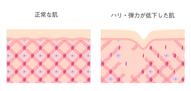 正常な肌とハリ・弾力が低下した肌の図