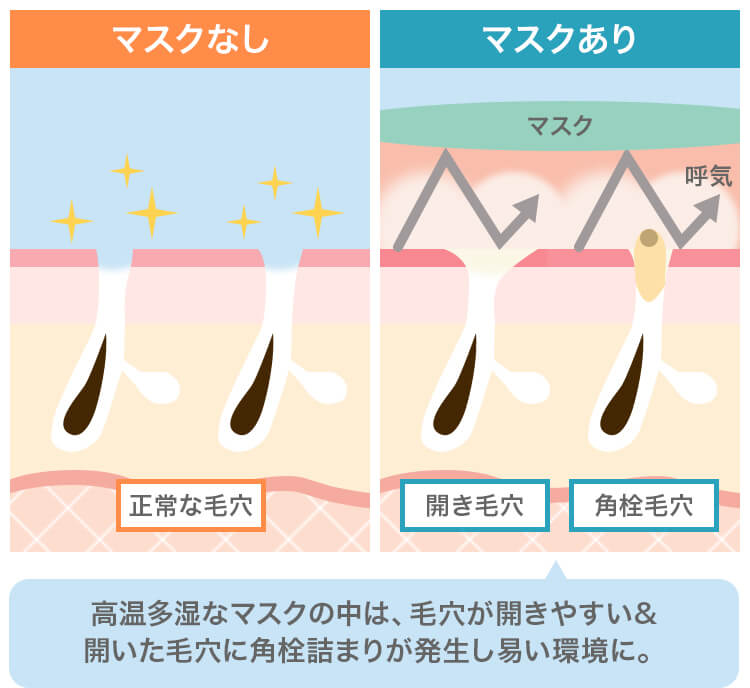 高温多湿なマスクの中は、毛穴が開きやすい&開いた毛穴に角栓詰まりが発生し易い環境に。