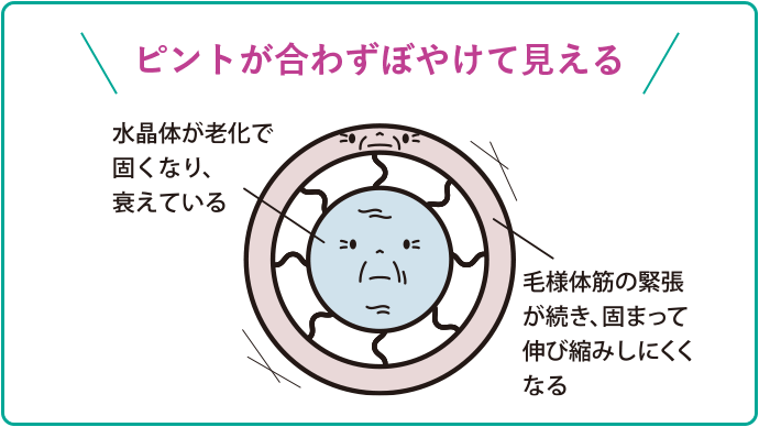 \ピントが合わずぼやけて見える/ 水晶体が老化で固くなり、衰えている 毛様体筋の緊張が続き、固まって伸び縮みしにくくなる