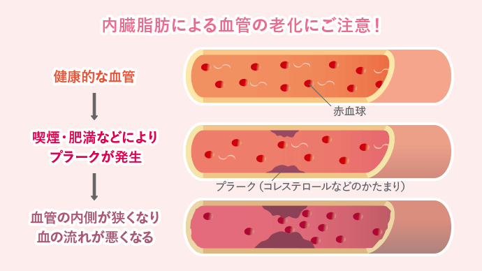 内臓脂肪による血管の老化にご注意! 健康的な血管→喫煙・肥満などによりプラークが発生→血管の内側が狭くなり血の流れが悪くなる