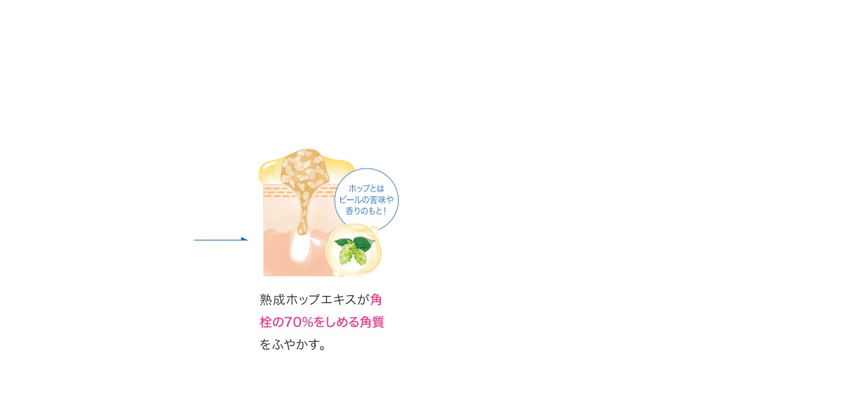 熟成ホップエキスが角栓の70%をしめる角質をふやかす。