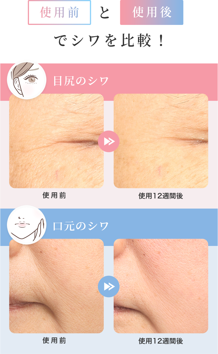 使用前と使用後でシワを比較! 目尻のシワ 口元のシワ