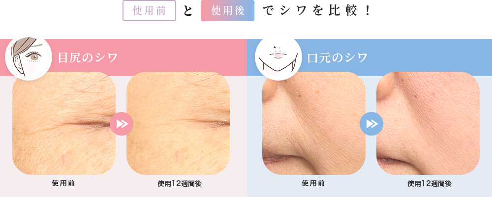 使用前と使用後でシワを比較! 目尻のシワ 口元のシワ