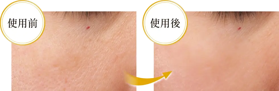 ハリ・弾力 Before・After