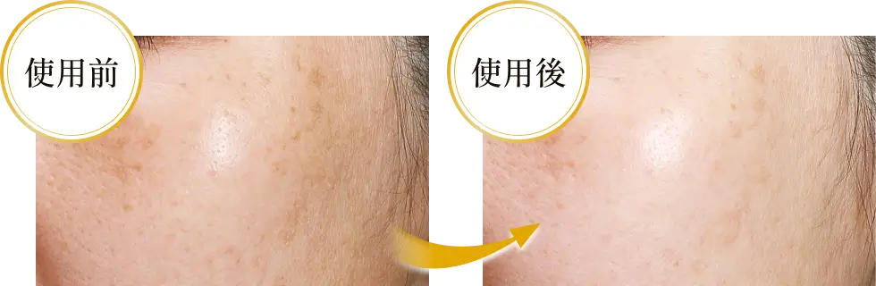 キメ・透明感 Before・After