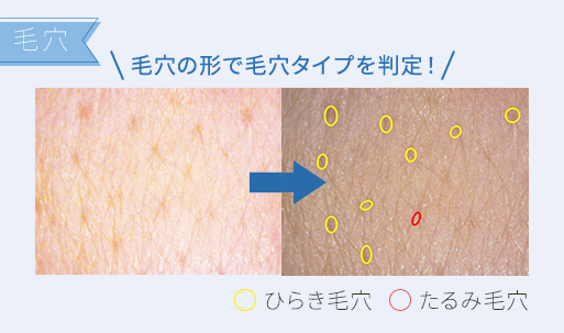 毛穴 毛穴の形で毛穴タイプを判定!ひらき毛穴 ●たるみ毛穴