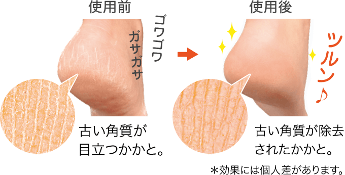 使用前 古い角質が 目立つかかと。 使用後 古い角質が除去 されたかかと。 ＊効果には個人差があります。